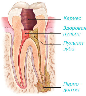 Кариес, пульпит зуба и периодонтит
