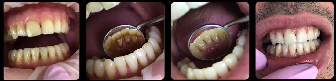 Чистка зубов от зубного камня фото до и после