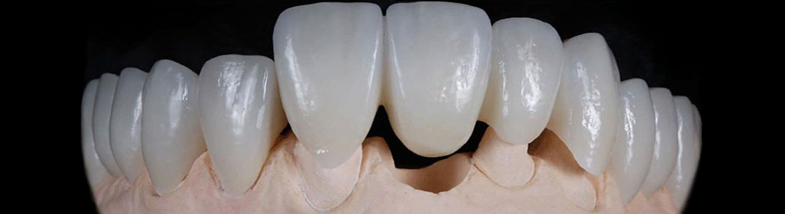 зубной мост из керамики