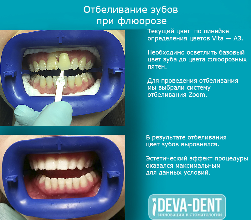 После проведения отбеливания зубов у пациентов может цена на домашние отбеливание зубов