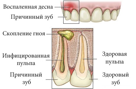 Все о зубном флюсе. Что делать если вылез флюс в десне (зубе). Лечение и Профилактика