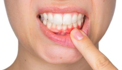 Лечение клиновидного дефекта зубов