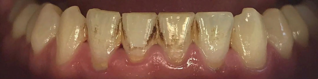 Чистка зубов от зубного камня фото до
