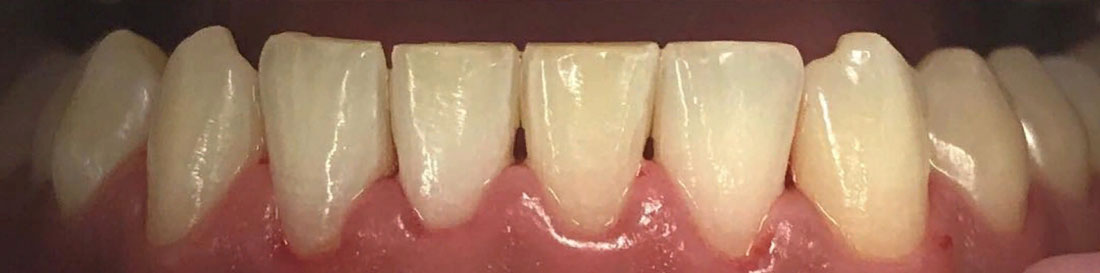 Чистка зубов от зубного камня фото после