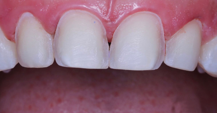 Обточка зубов перед установкой композитных виниров