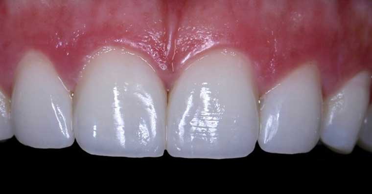 Обточка зубов перед установкой композитных виниров