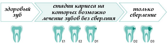 Стадии кариеса. Начальная степень кариеса.