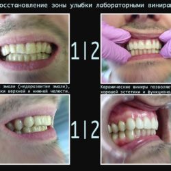 Пример художественной реставрации зубов