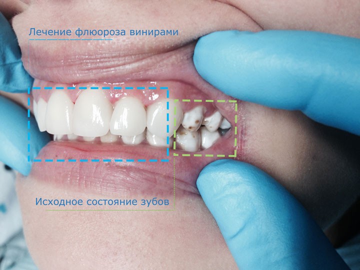 Поражение зубов из-за избытка фтора в воде: лечение флюороза