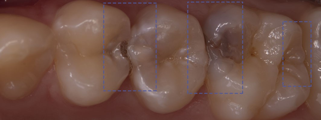 Виды пломб для зубов