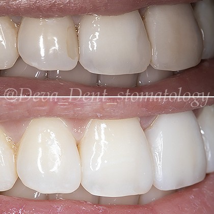 Прямая или композитная реставрация зубов