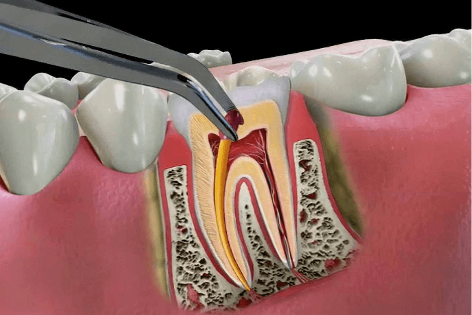 Когда проводится лечение каналов зубов?