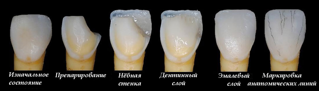 Этапы реставрации зубов