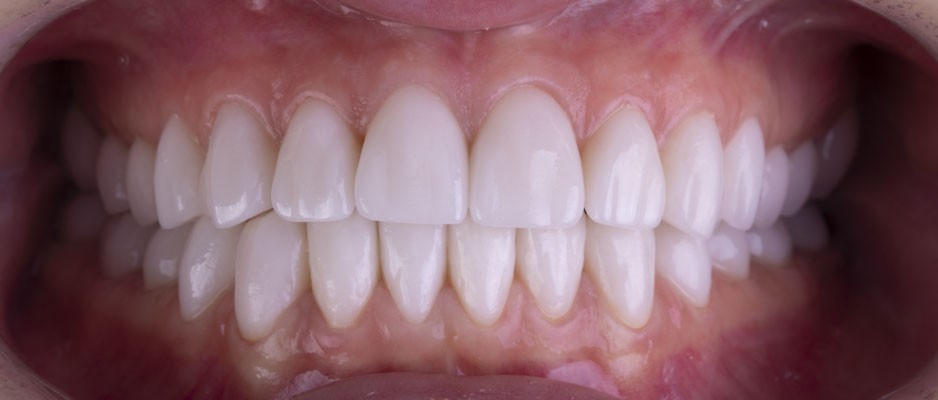 Тотальные реставрации зубов