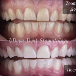 Фото отбеливания Zoom 4 До и После