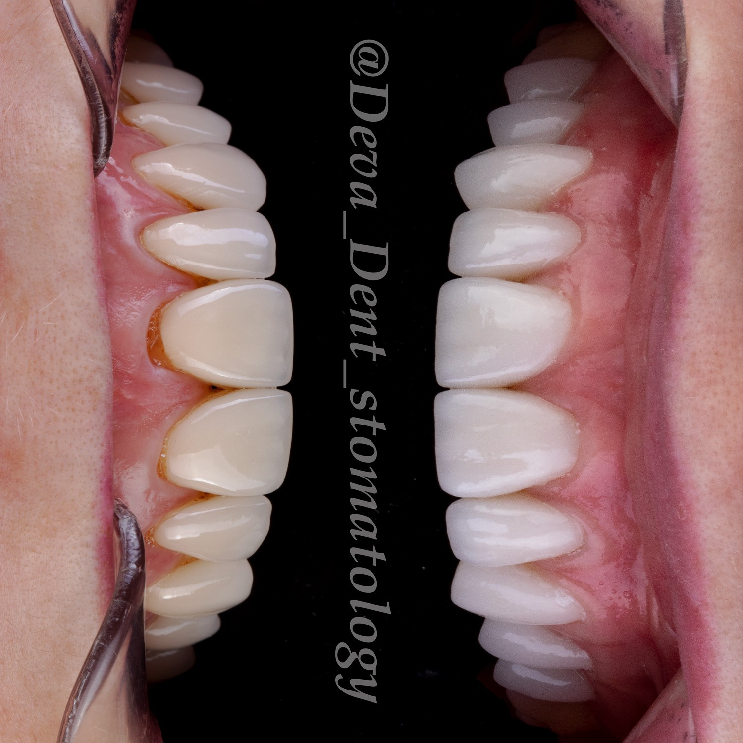 Тотальные реставрации зубов