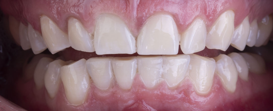Отбеливание зубов Zoom 4 (Зум 4)